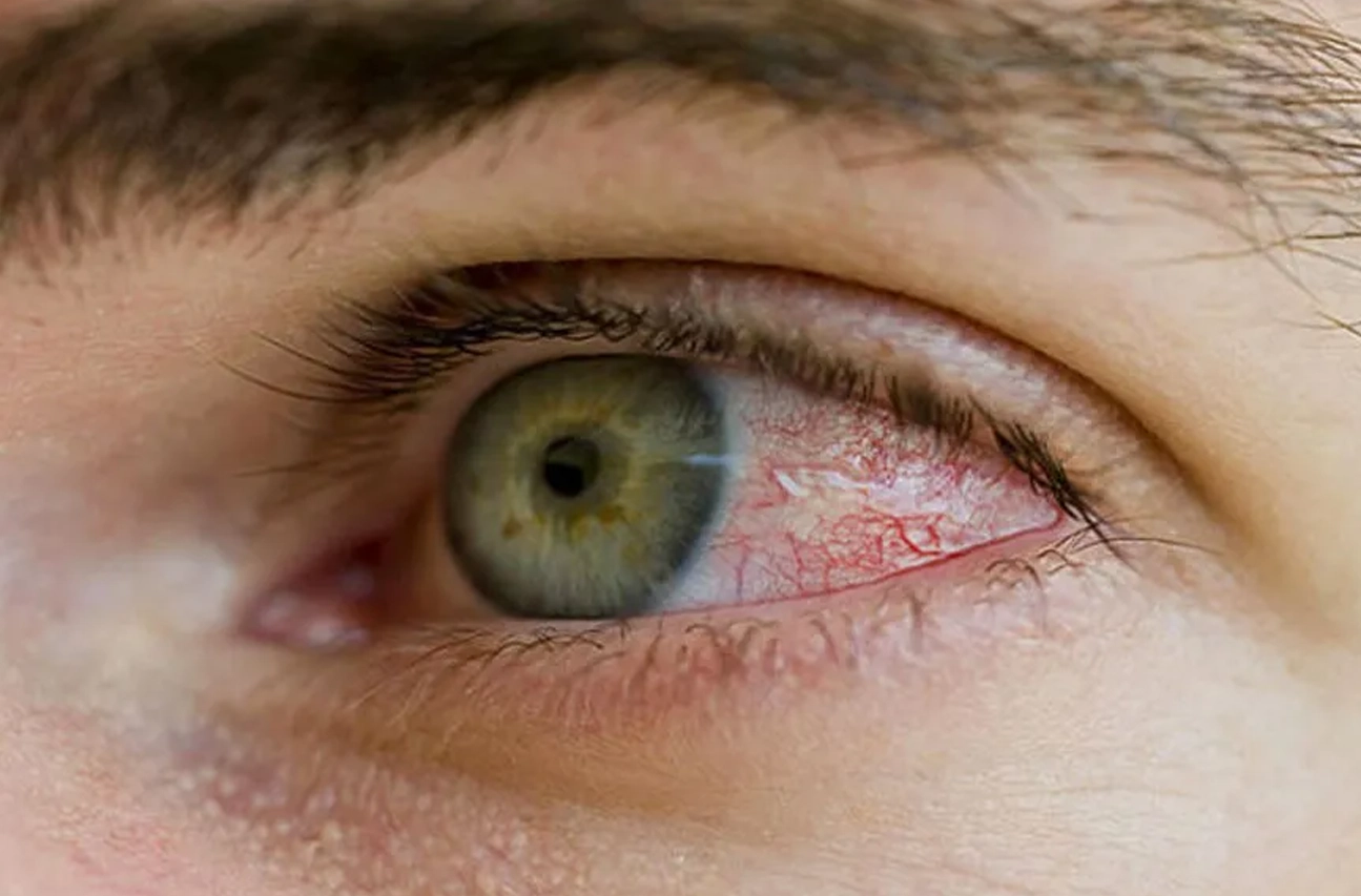 Diyabetik Retinopati